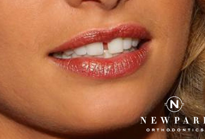 gapped tooth - Newpark orthodontics
