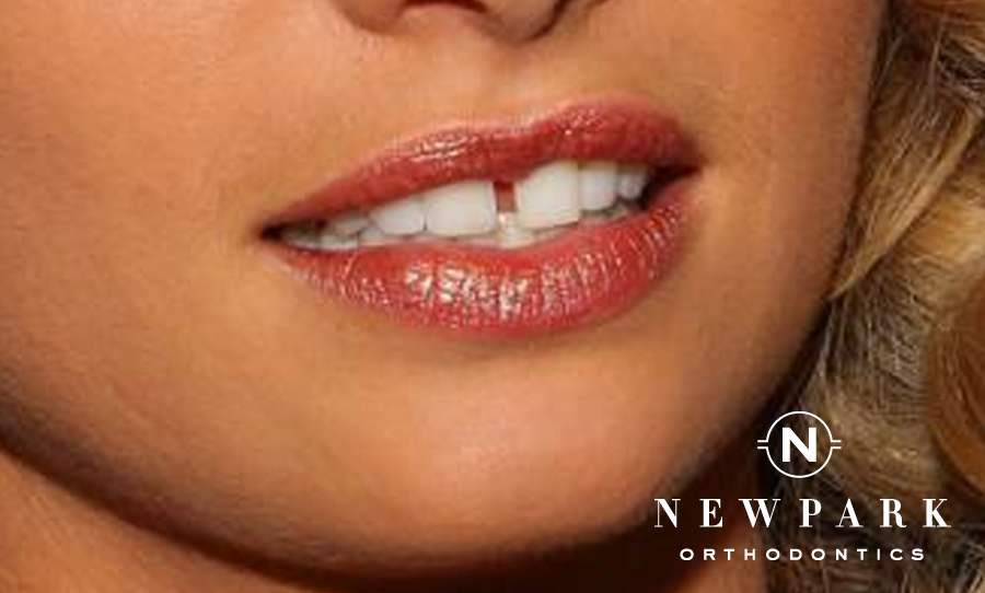 gapped tooth - Newpark orthodontics