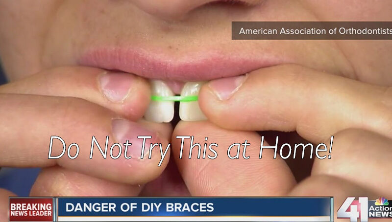 child using a rubber band to fix gapped tooth