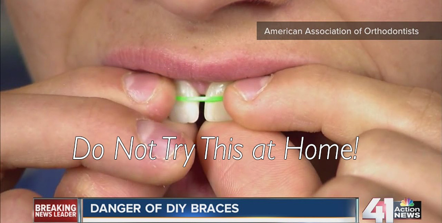 child using a rubber band to fix gapped tooth