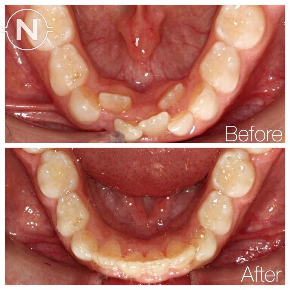 Early Orthodontic Treatment Case 1 Before After Image