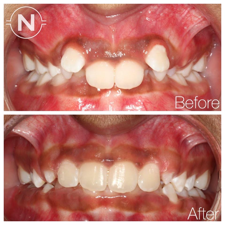 Early Orthodontic Treatment Case 2 Before After Image