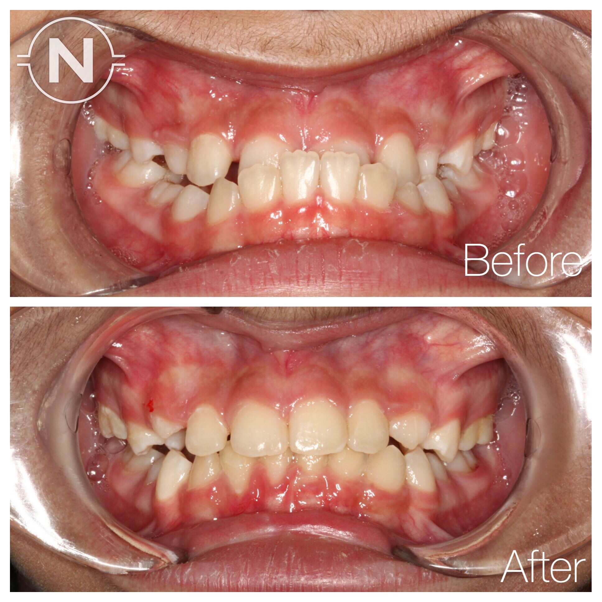Early Orthodontic Treatment Case 3 Before After Image
