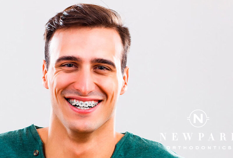 Adult Braces Alpharetta - FAQs