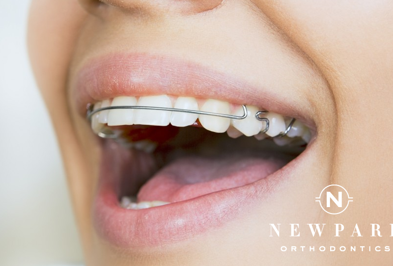 Post Braces Treatment - Newpark Orthodontics
