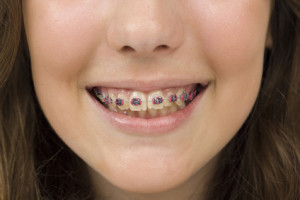 Bright mouth with braces and young woman smile