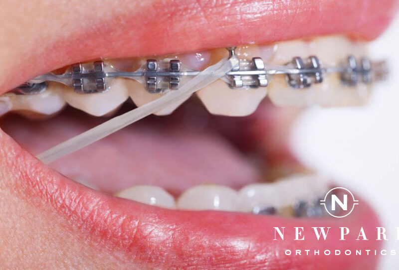 Rubber bands on braces can help your teeth move even faster.