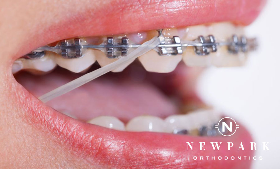 Rubber bands on braces can help your teeth move even faster.