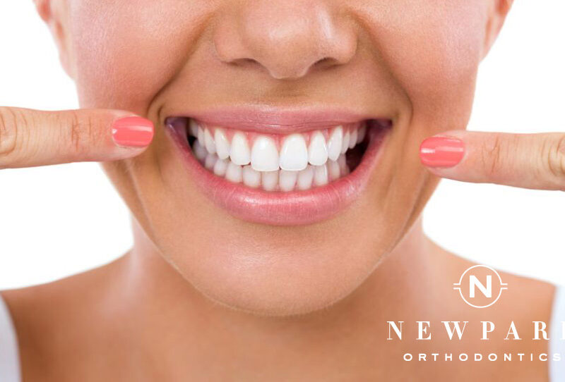 Teeth White Cleaning - Newpark Orthodontics