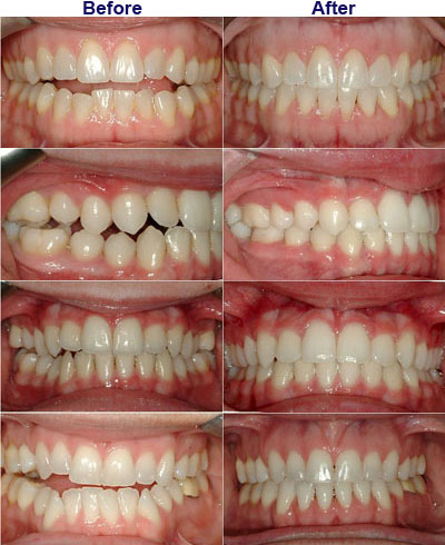 where should our tongue be when chewing and swallowing?
