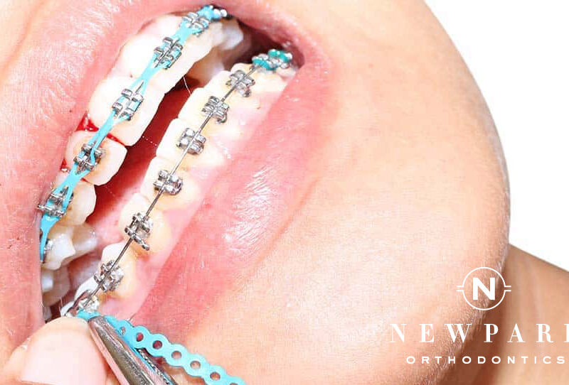 Roswell Braces FAQ - Newpark Orthodontics