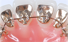 Lingual Braces Alpharetta