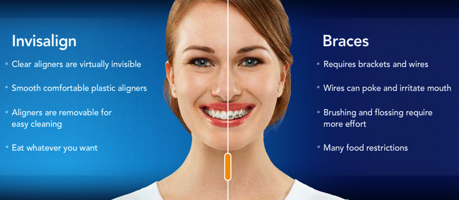 invisalign advantages over braces