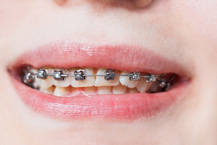 front view of dental braces on teeth of upper jaw before Orthodontic Treatment