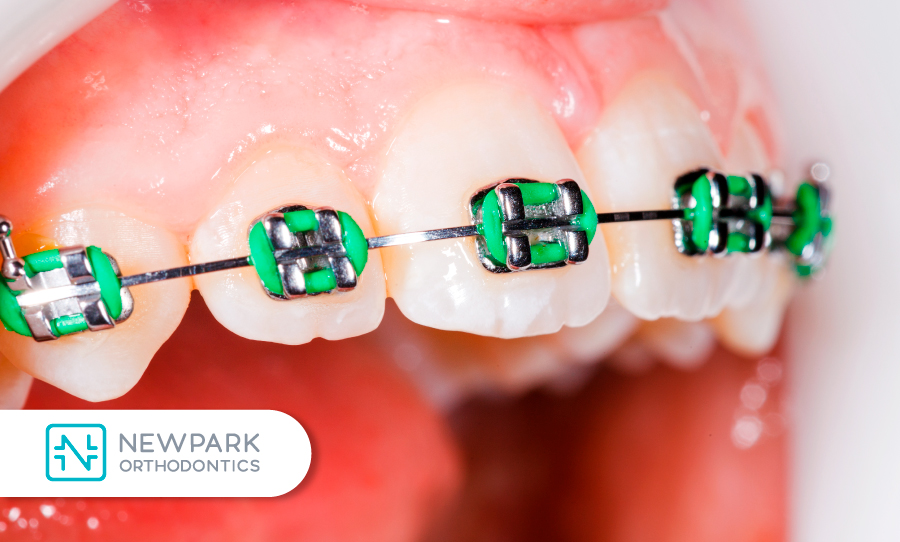 the history of braces teaches us a lot about orthodontics and what we can do.