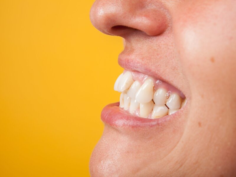 underbite treatment near alpharetta georgia