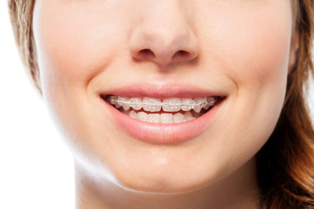 clear braces in Alpharetta, GA