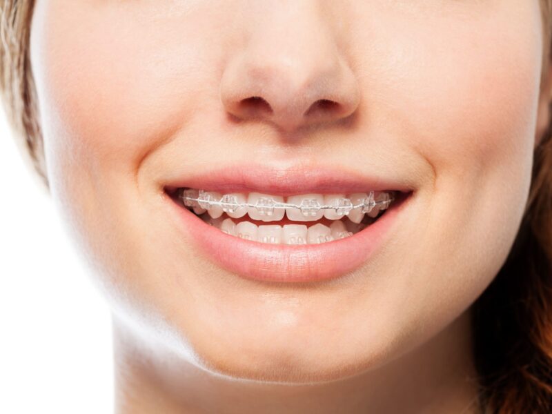 clear braces in Alpharetta, GA