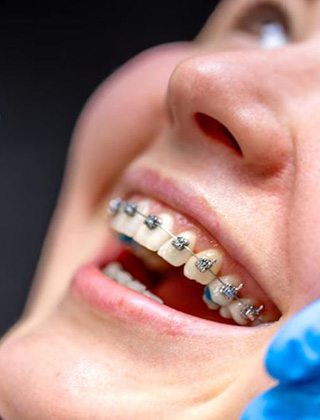 img-newparkorthodontics-adulttreatment-01