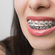 img-newparkorthodontics-johnscreek-traditionalbraces