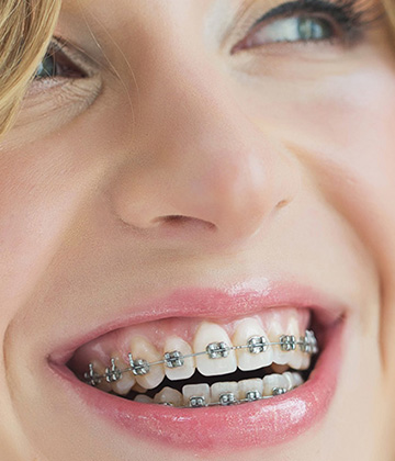 img-newparkorthodontics-treatment-braces-lifewithbraces