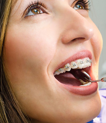 img-newparkorthodontics-treatment-braces-metalbraces
