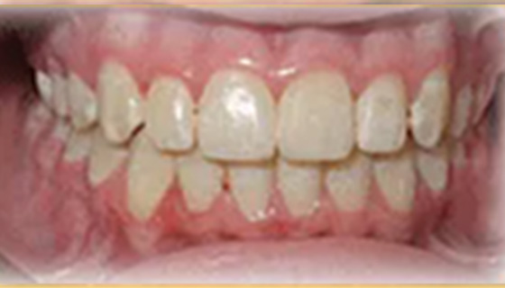 img-newparkorthodontics-treatment-commontreatment-crowding-before