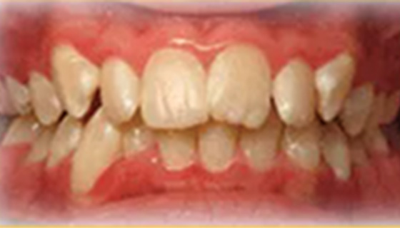 img-newparkorthodontics-treatment-commontreatment-crowding-before