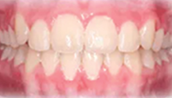 img-newparkorthodontics-treatment-commontreatment-openbite-after