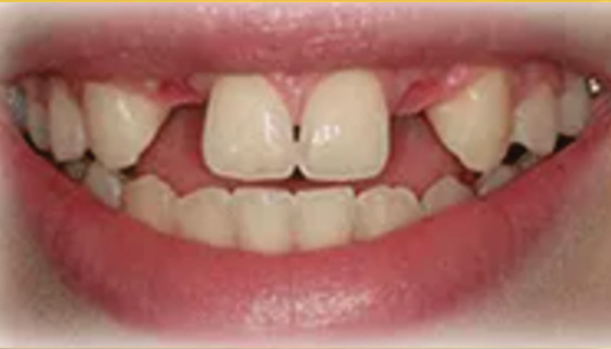 img-newparkorthodontics-treatment-missingteeth-before