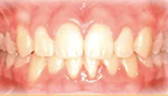 img-newparkorthodontics-treatment-overbite-after