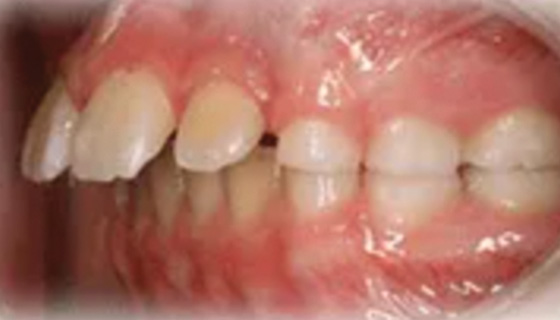 img-newparkorthodontics-treatment-overjet-before