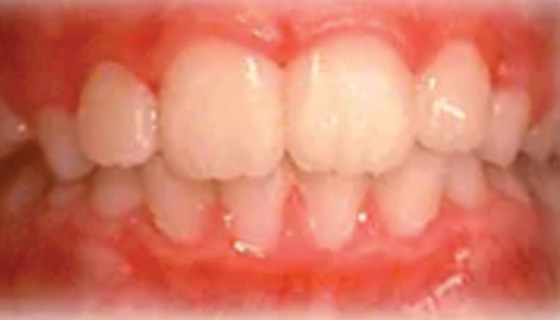 img-newparkorthodontics-treatment-phaseone-after