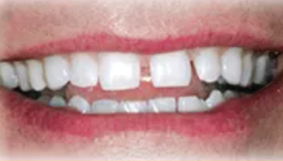 img-newparkorthodontics-treatment-teethspacing-before