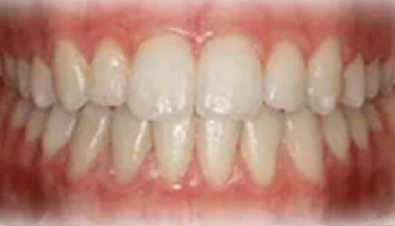 img-newparkorthodontics-treatment-underbite-after