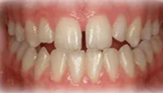 img-newparkorthodontics-treatment-underbite-before