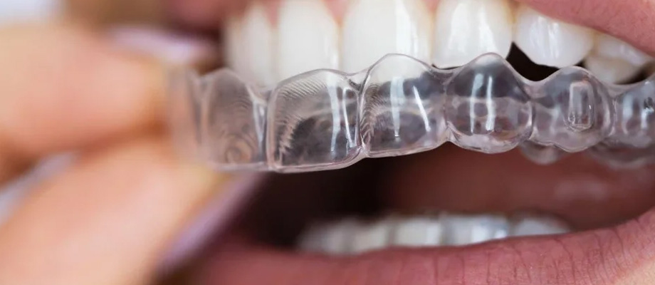 img-newparkorthodontics-typesofbraces-03