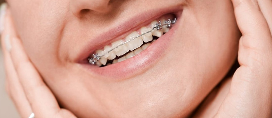 img-newparkorthodontics-typesofbraces-04